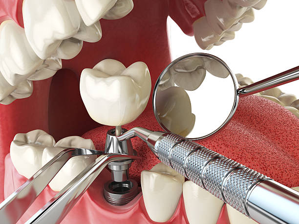 Best Emergency Root Canal Treatment in Harbor Beach, MI